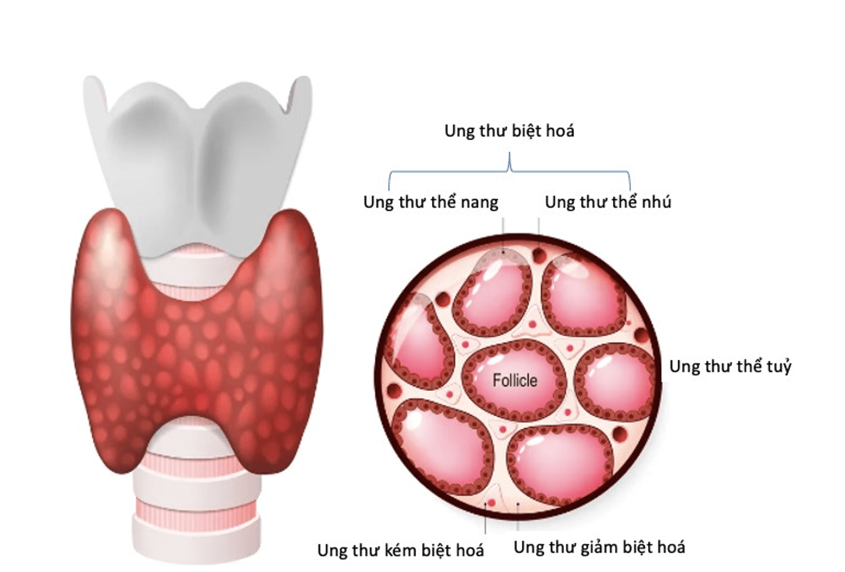 Ung Thư Tuyến Giáp