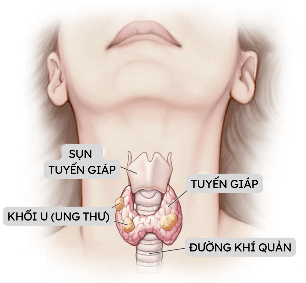 Ung Thư Tuyến Giáp