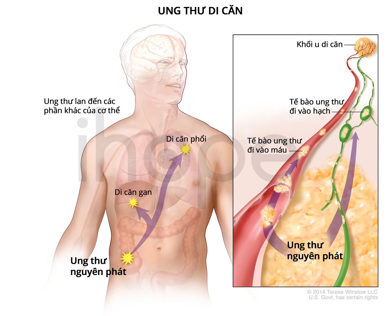 Ung Thư Vú Di Căn Gan 2