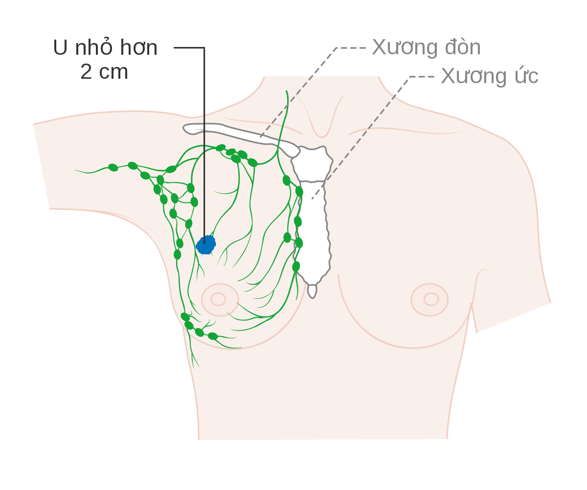 Ung Thư Vú 1